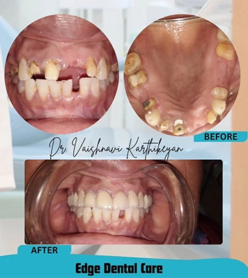 Smiling patient showing complete teeth restoration after professional dental implant procedure in Alwarpet
