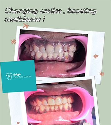 View before & after images showing expert dental care outcomes and confident smile improvements Alwarpet