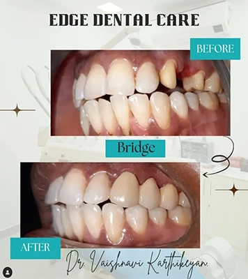 Patient teeth transformation showing visible results before and after complete treatment in Alwarpet