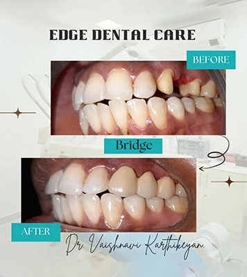 Example of dental bridge treatment restoring missing teeth & improving overall oral smile in Alwarpet