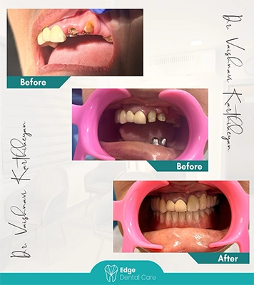 Professional dental before and after treatment images reflecting smiles and healthy teeth in Alwarpet