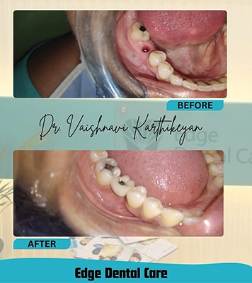 Close-up of teeth after dental implant placement showing natural appearance and alignment in Alwarpet