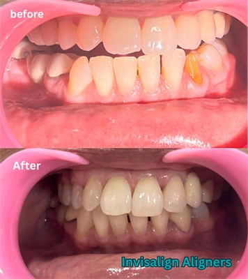 Explore visible before and after treatment results showing improved smiles & oral health in Alwarpet