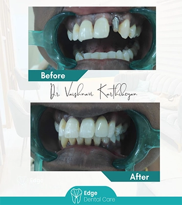 Restored patient smile after successful dental implant procedure performed professionally in Alwarpet