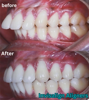 Achieve perfect frontal teeth restoration through advanced procedures ensuring results in Alwarpet