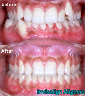 Experience gum bleeding treatment from skilled dental experts ensuring gentle oral care in Alwarpet.