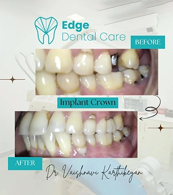 Close-up showing successful dental implant crown placement to restore missing teeth & smile Alwarpet