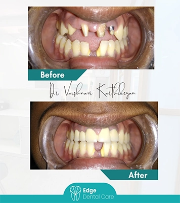 Dental implant procedure in progress restoring missing teeth and ensuring perfect smile in Alwarpet