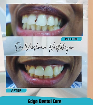 Happy patient smiling after the professional dental treatment with restored healthy teeth in Alwarpet