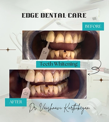 Patient receiving professional teeth whitening procedure to achieve brighter confident smile Alwarpet