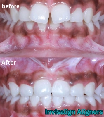 Receive advanced tooth treatment to restore strength, aesthetics, complete dental health in Alwarpet