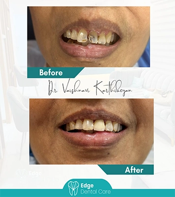Comparison of patient teeth condition before and after professional dental care procedure in Alwarpet