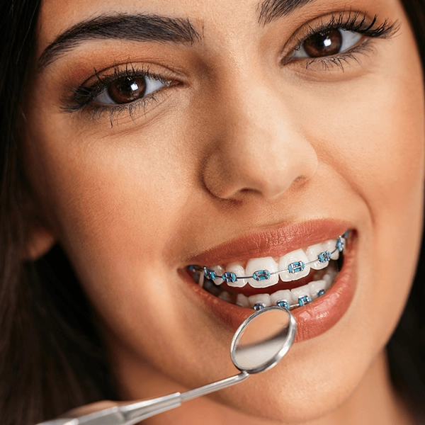 Check if you need braces for misaligned teeth with expert orthodontic assessment and care Alwarpet