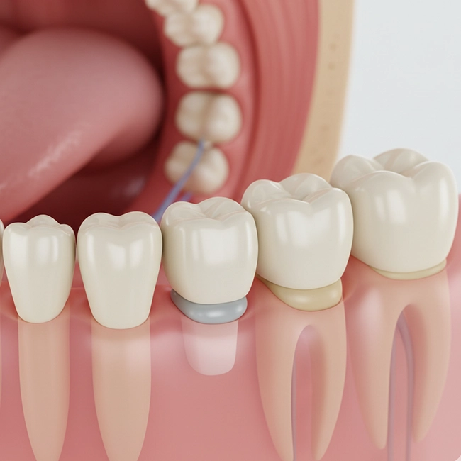 Improve your smile with cosmetic and restorative dental crowns and bridges designed in Alwarpet.