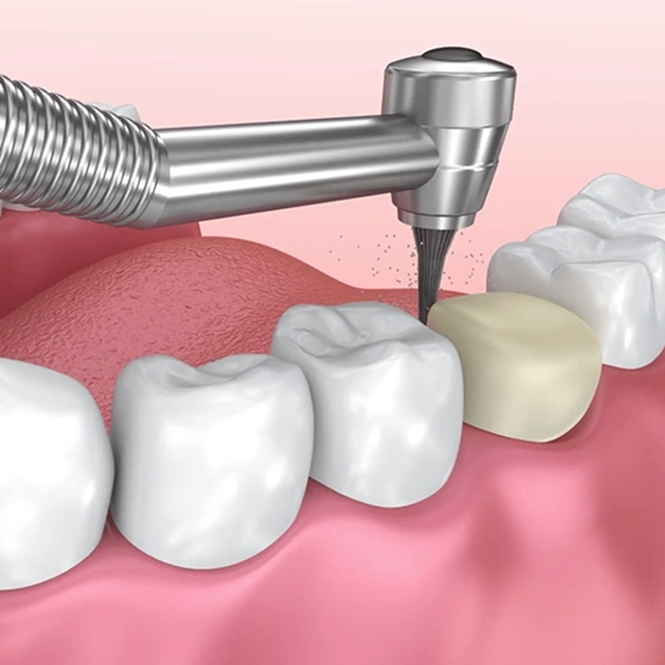 Identify when you need dental crowns and bridges to restore damaged or missing teeth in Alwarpet.
