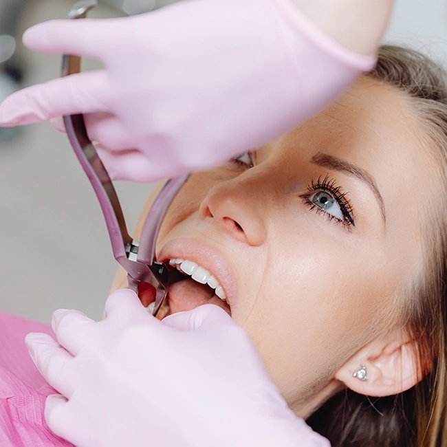 Expert dentists provide safe & painless tooth extraction or removal treatments in Alwarpet, Alwarpet