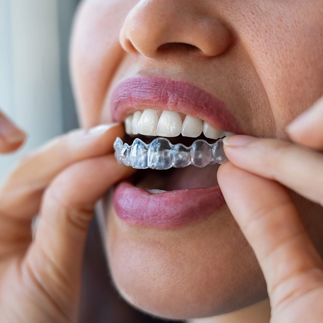 Orthodontists provide invisible aligners & braces for straight, healthy teeth with expert care Alwarpet