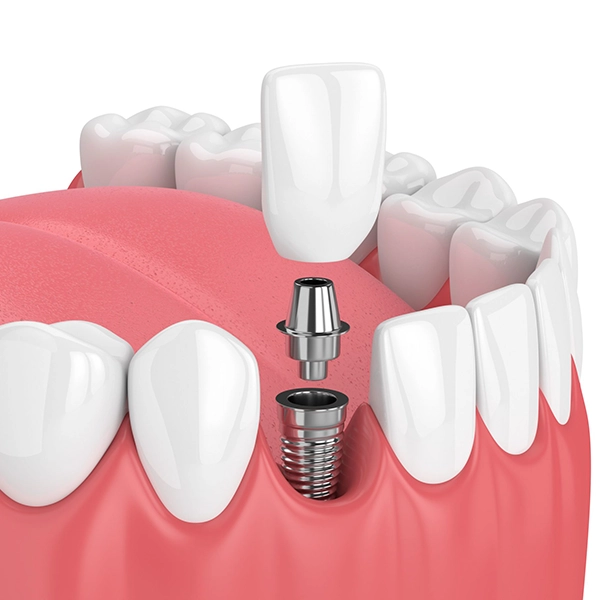 Dentists provide expert guidance on when & how patients should consider tooth replacement Alwarpet