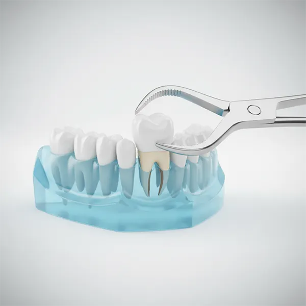 Expert dentists provide safe and effective tooth extraction treatments for patients Alwarpet, Alwarpet