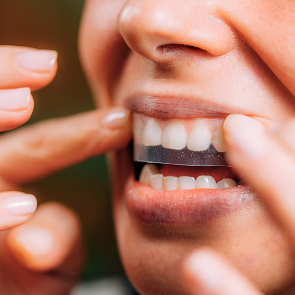 Check these signs before teeth whitening—sensitivity, gum issues, cavities, or restorations 